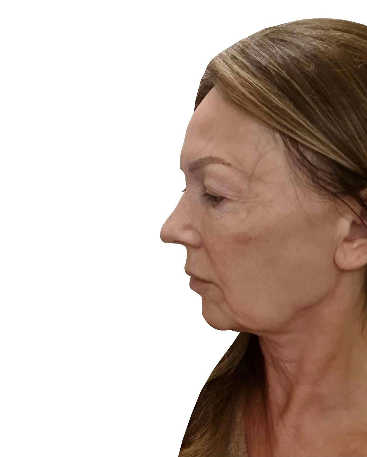 Upper Blepharoplasty, Lower Face and Neck Lift