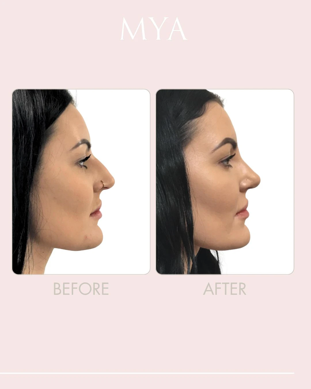 showcasing the main reasons to get a rhinoplasty