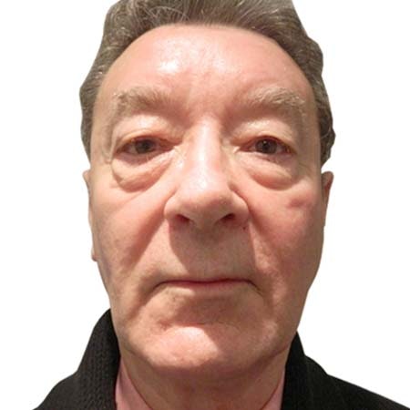 Eye bag male patient 2 - pre-op