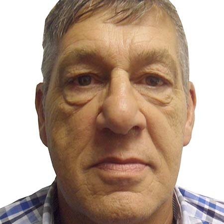 Eye bag male patient 1 - pre-op