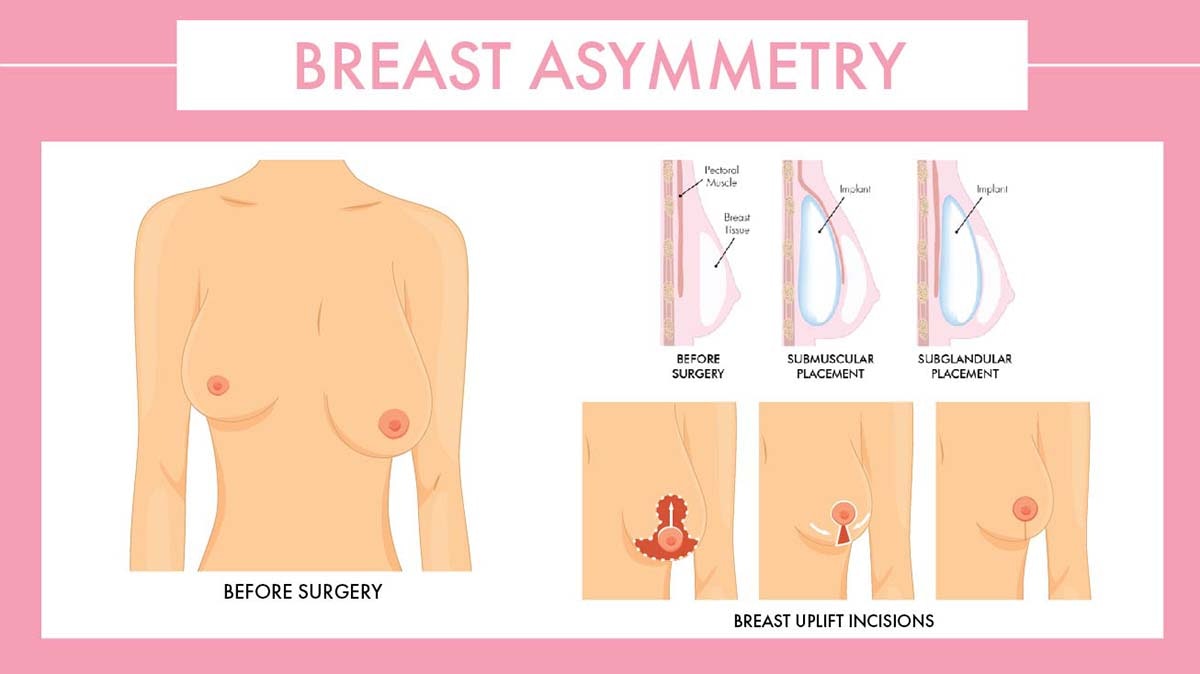 Breast Asymmetry Diagram