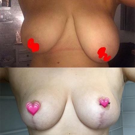 breast asymmetry patient story