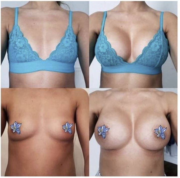 breast enlargement patient story