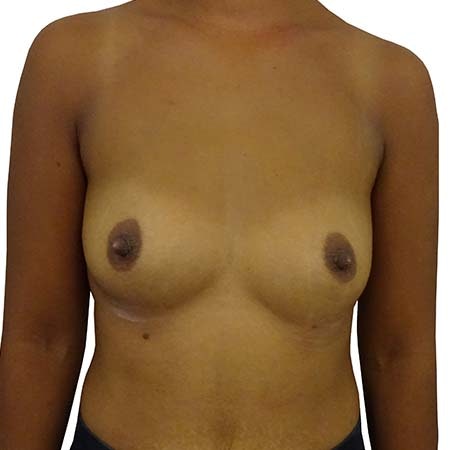 breast enlargement patient 2 - pre-op