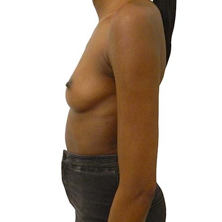 breast enlargement patient 3 - pre-op