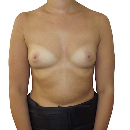 breast enlargement patient 4 - pre-op