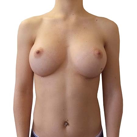 breast enlargement patient 5 - post-op