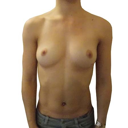 breast enlargement patient 5 - pre-op