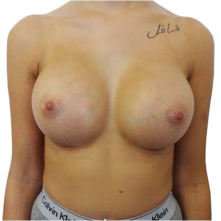 breast enlargement patient 9 - post-op