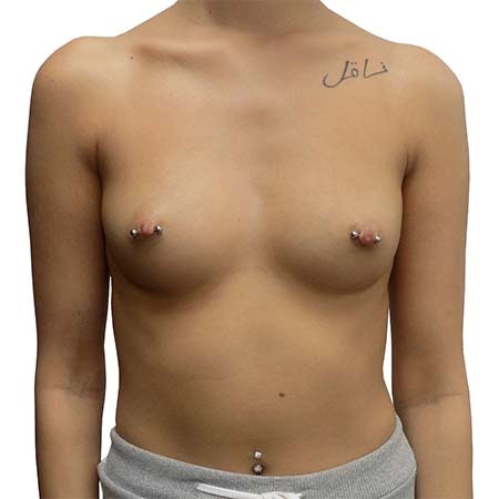 breast enlargement patient 9 - pre-op