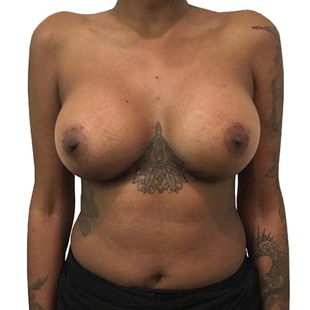 After Breast Enlargement