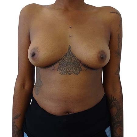 Before Breast Enlargement