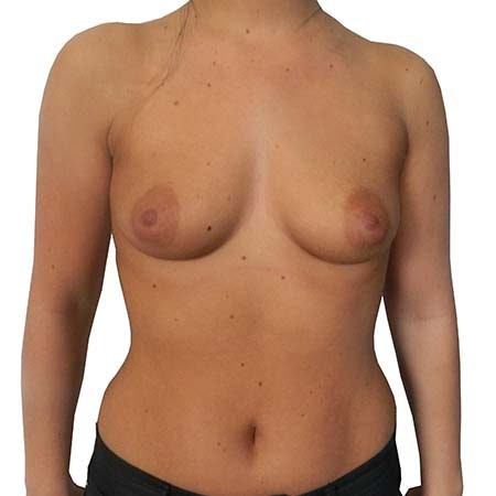 breast enlargement patient 14 - pre-op