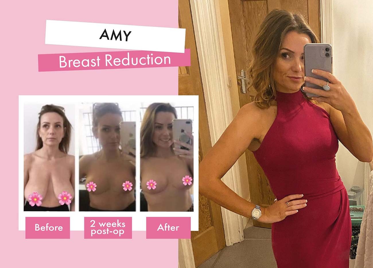 amy_andthekidsxx Breast Reduction Patient Story