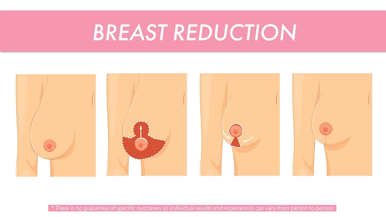 Breast Reduction Diagram