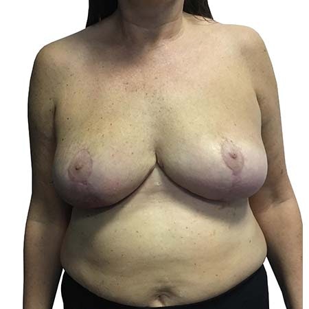 Breast Reduction Patient 12 - pre-op