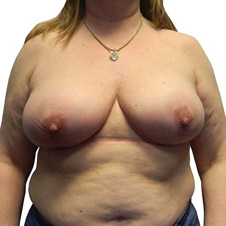 Breast Reduction Patient 11 - post-op