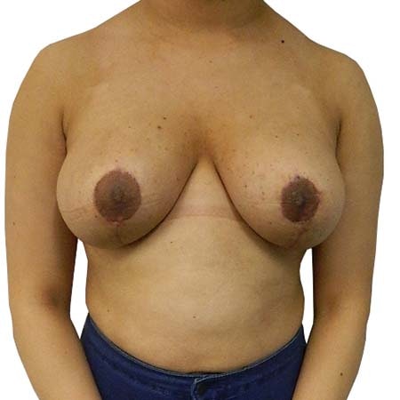 Breast Reduction Patient 7 - post-op