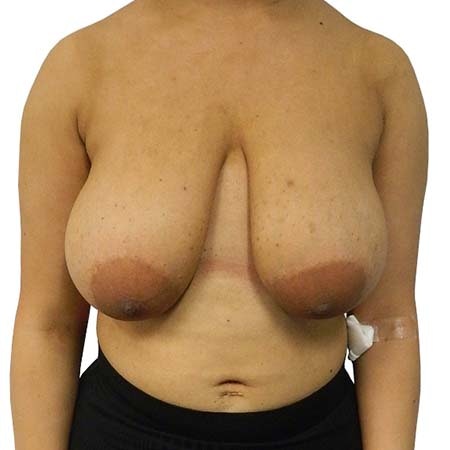 Breast Reduction Patient 7 - pre-op