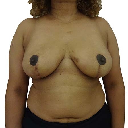 Breast Reduction Patient 6 - post-op