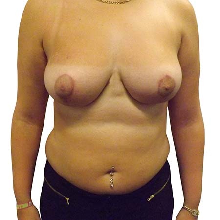 Breast Reduction Patient 1 - post-op