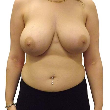 Breast Reduction Patient 1 - pre-op