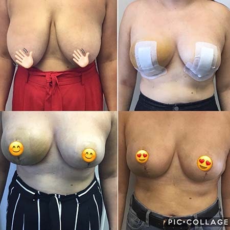 Breast Reduction Patient Story