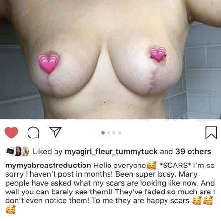 Breast Reduction Patient Story