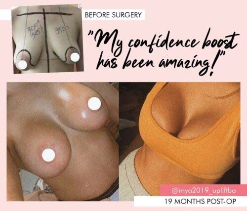 Breast Uplift Patient Story confidence boost