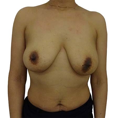 Breast Uplift Patient 1 - pre-op