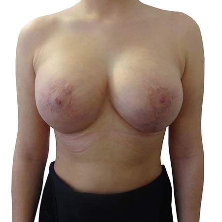 Breast Uplift Patient 2 - post-op