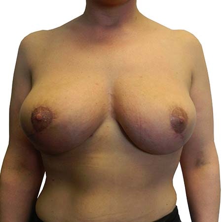 Breast Uplift Patient 3 - post-op