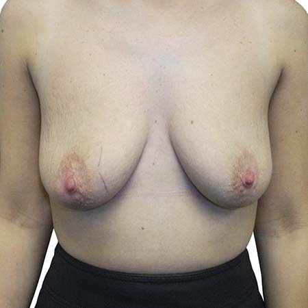 Breast Uplift Patient 8 - pre-op
