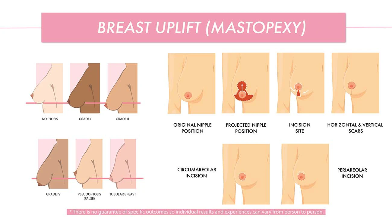 Educational infographic explaining breast uplift (mastopexy) surgery. On the left, a series of side-view breast illustrations demonstrate different levels of breast drooping, including no ptosis and varying grades of ptosis. On the right, step-by-step diagrams show how breast lift surgery repositions the nipple, removes excess skin, and reshapes the breast to create a more lifted contour. Additional illustrations highlight common incision patterns and the location of breast lift surgery scars, helping patients understand how a mastopexy procedure is performed.