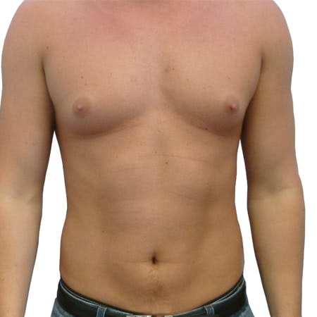 male chest reduction patient 1 - pre-op