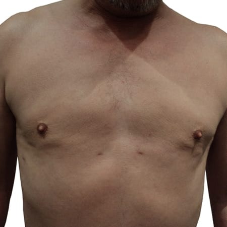 male chest reduction patient 2 - post-op