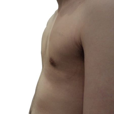 male chest reduction patient 3 - post-op
