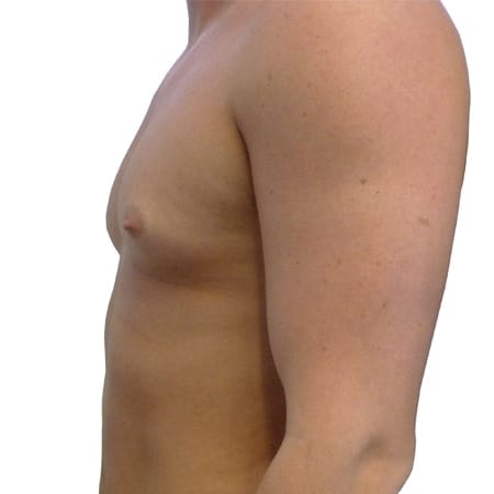 male chest reduction patient 4 - pre-op
