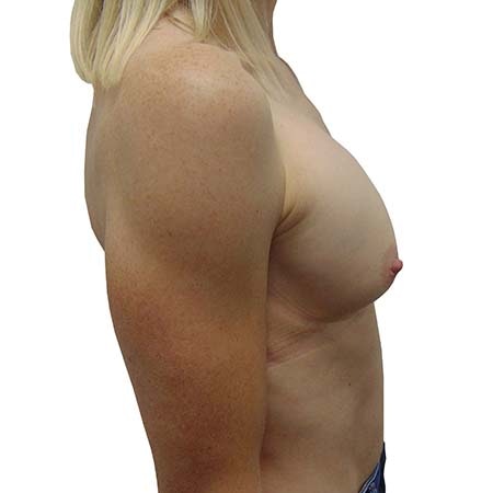 reaugmentation patient 2 - pre-op