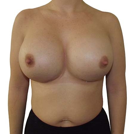 reaugmentation patient 11 - post-op