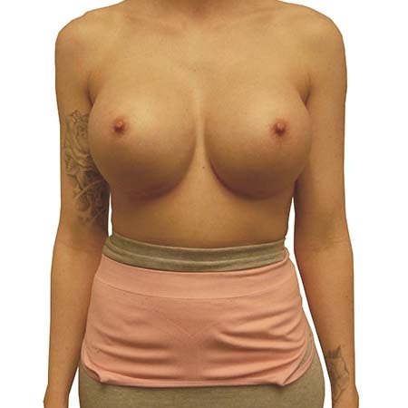 reaugmentation patient 10 - post-op