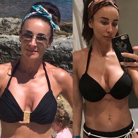 reaugmentation patient story