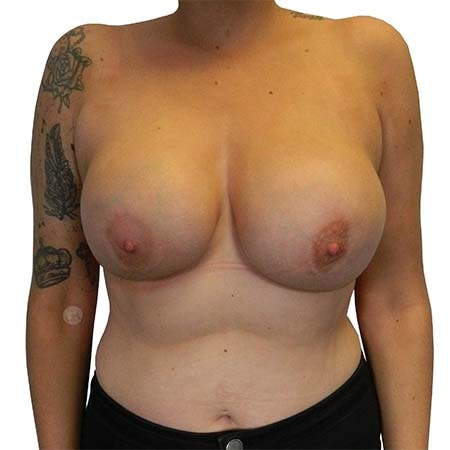 reaugmentation patient 9 - pre-op