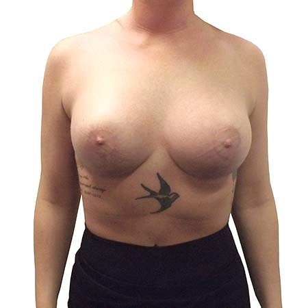 reaugmentation patient 7 - post-op