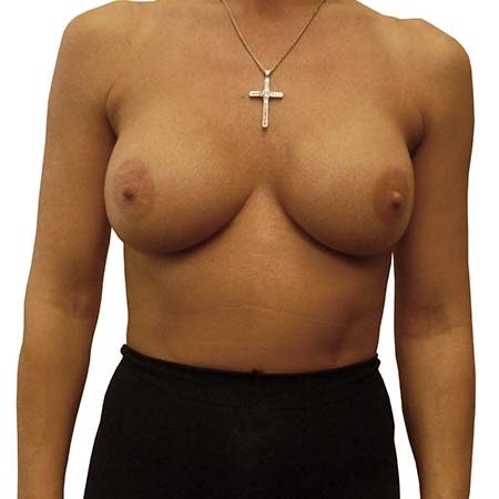 reaugmentation patient 6 - pre-op