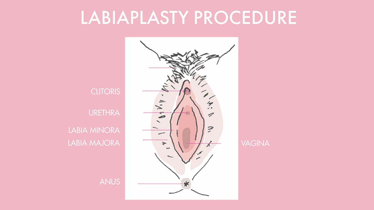 Labiaplasty procedure diagram