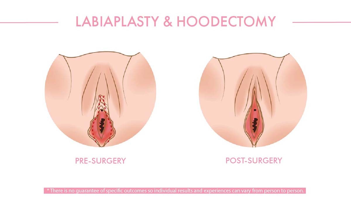 Labiaplasty Diagram pre & post surgery