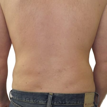 Liposuction men patient 10 - post-op