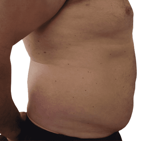 Liposuction men patient 9 - pre-op