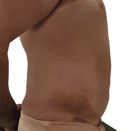Liposuction men patient 9 - post-op